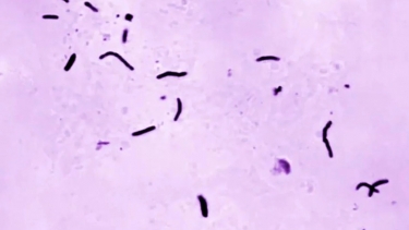 ২০২৪ সালে যক্ষ্মায় মারা গেছে ১২ লাখের বেশি মানুষ: বিশ্ব স্বাস্থ্য সংস্থা